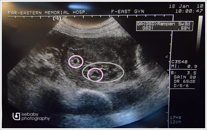 [5W2D] 大驚!! 二枚胚胎!!!!!!